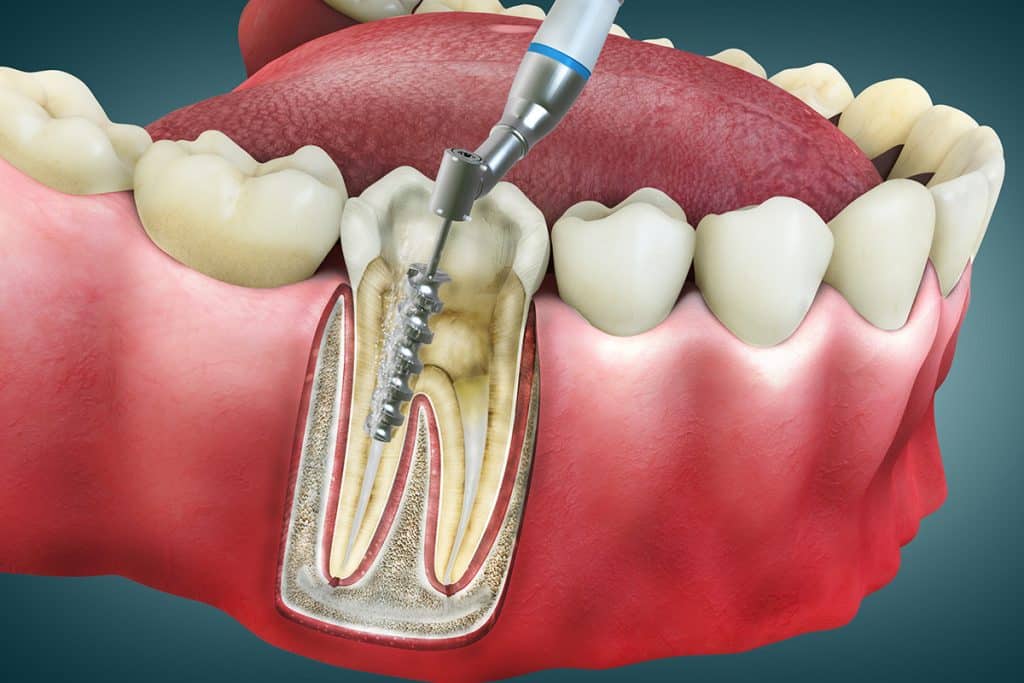 How Much Does a Root Canal Cost in Venice, FL?